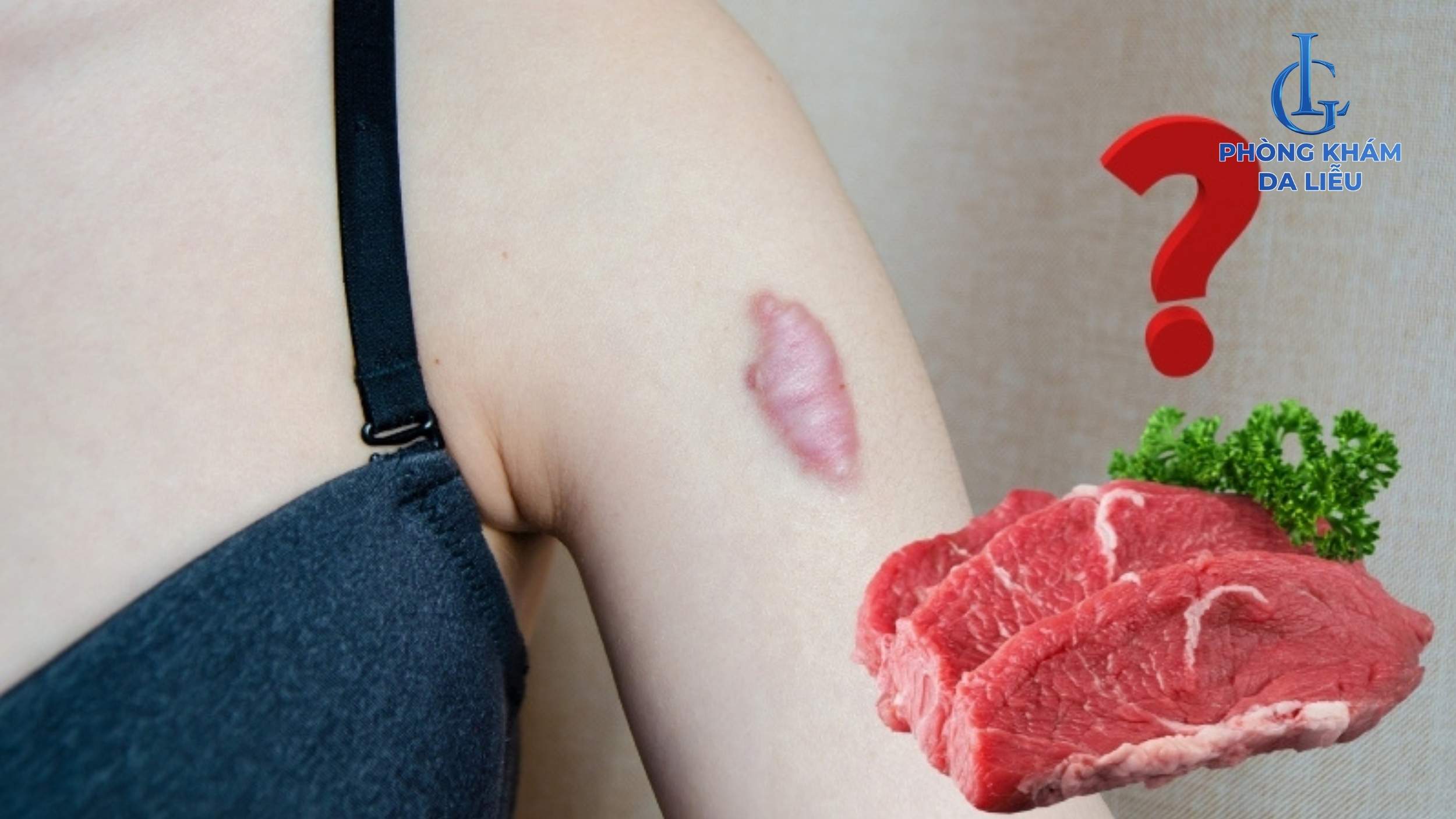 Ăn thịt bò có bị sẹo lồi không?