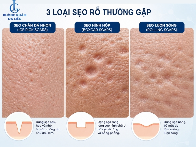 các loại sẹo rỗ thường gặp