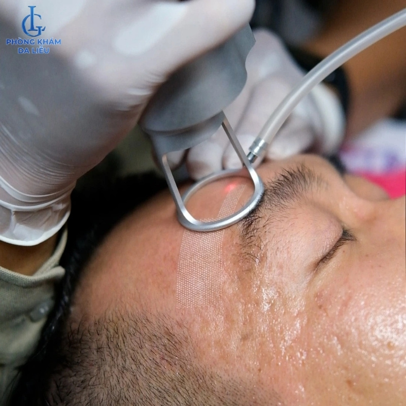 Trị sẹo rỗ bằng laser co2