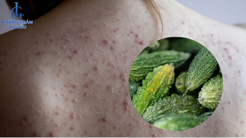 cách điều trị mụn lưng tại nhà bằng mướp đắng