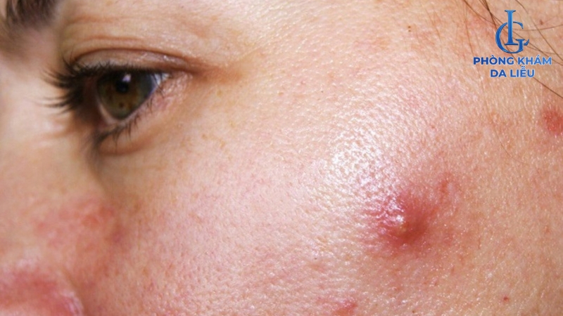 Mụn viêm đỏ không nhân