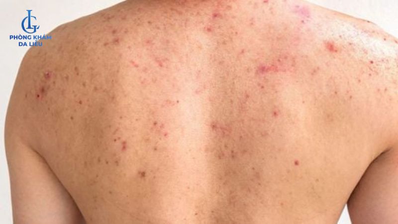 tình trạng mụn ở lưng