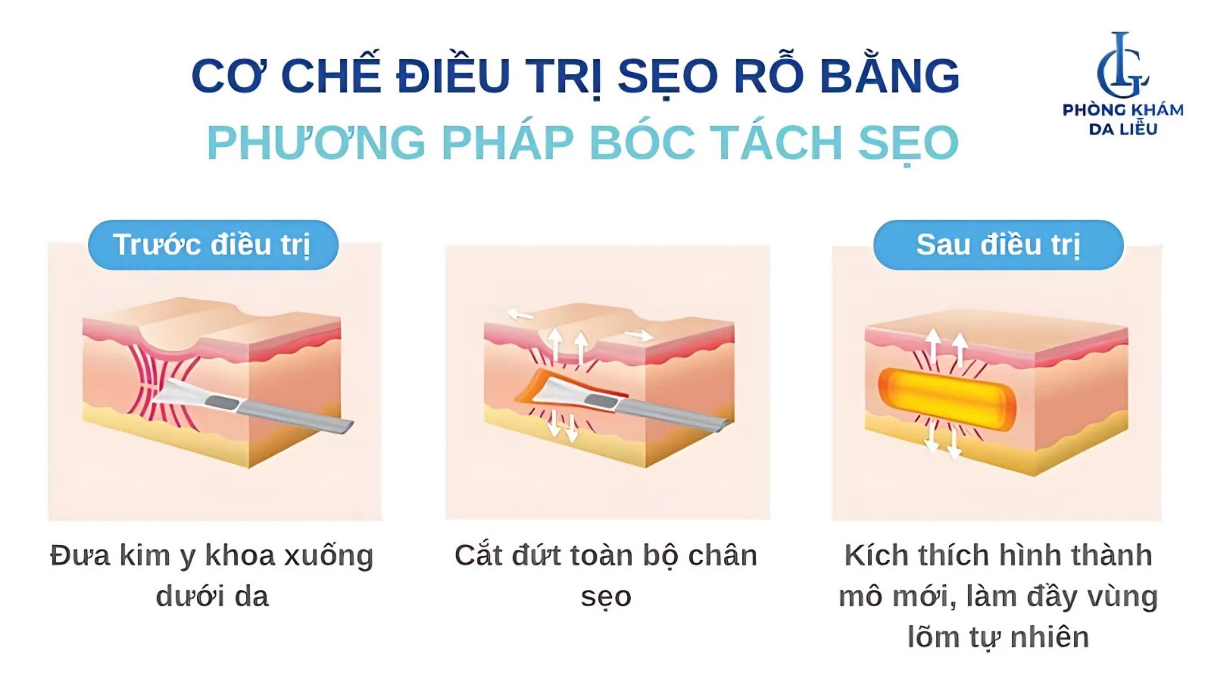 Bóc tách đáy sẹo