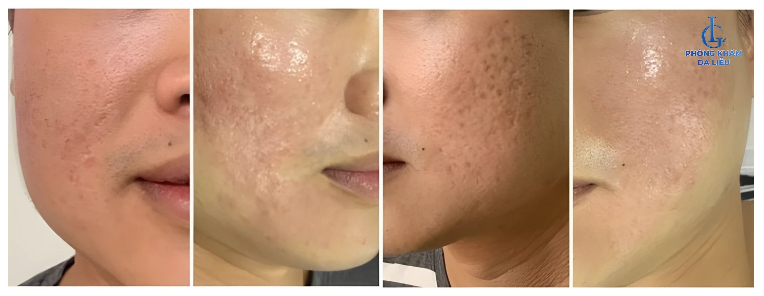 điều trị sẹo rỗ