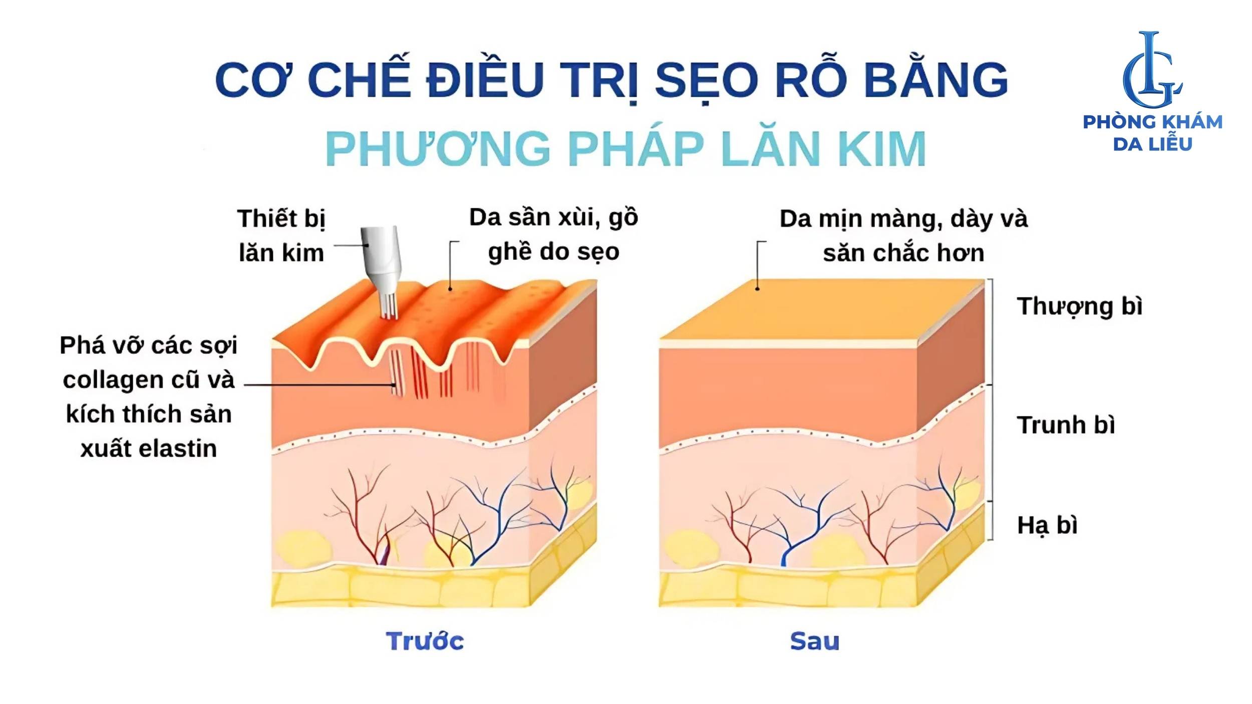 Lăn kim trị sẹo rỗ