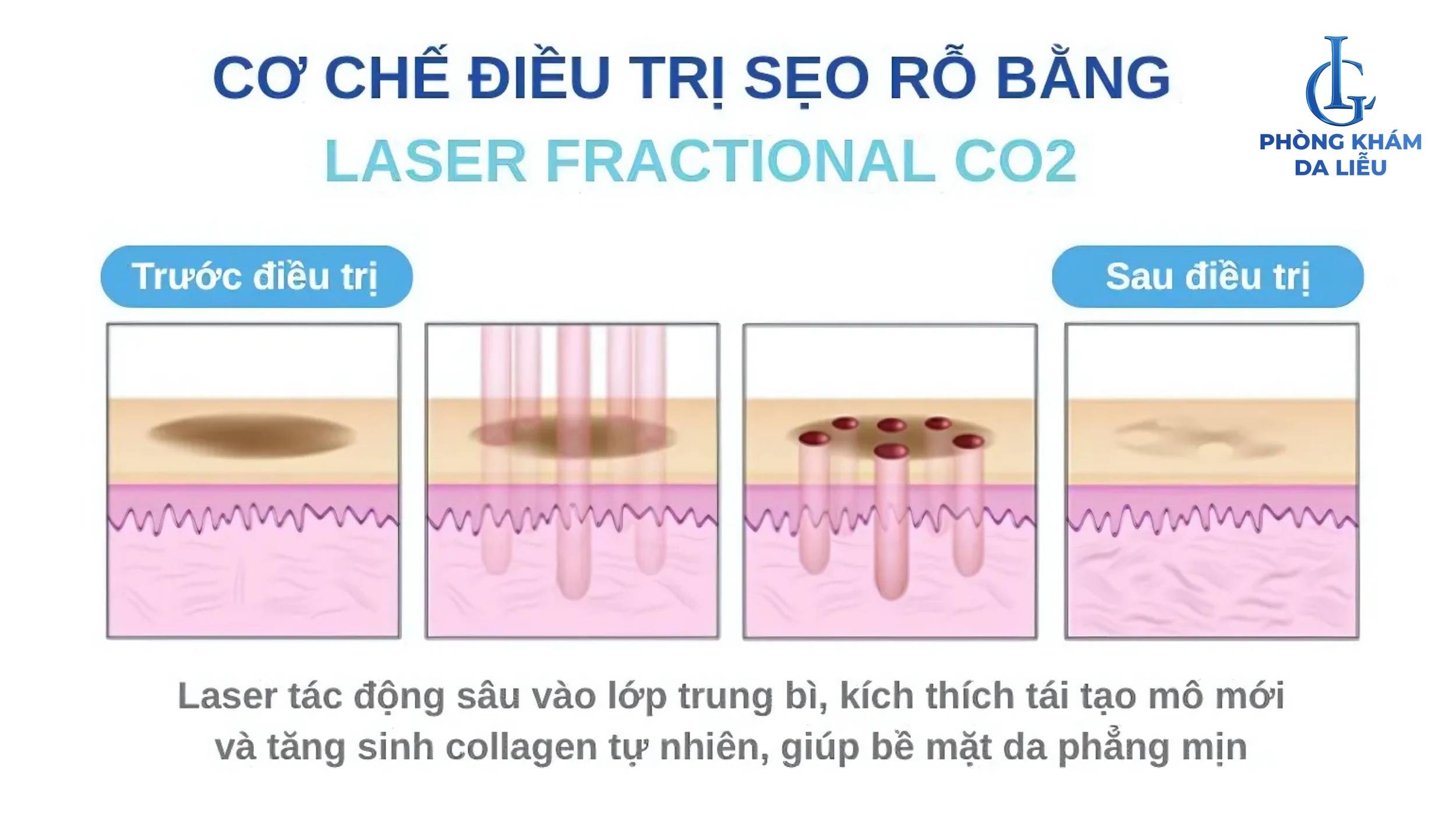 trị sẹo rỗ