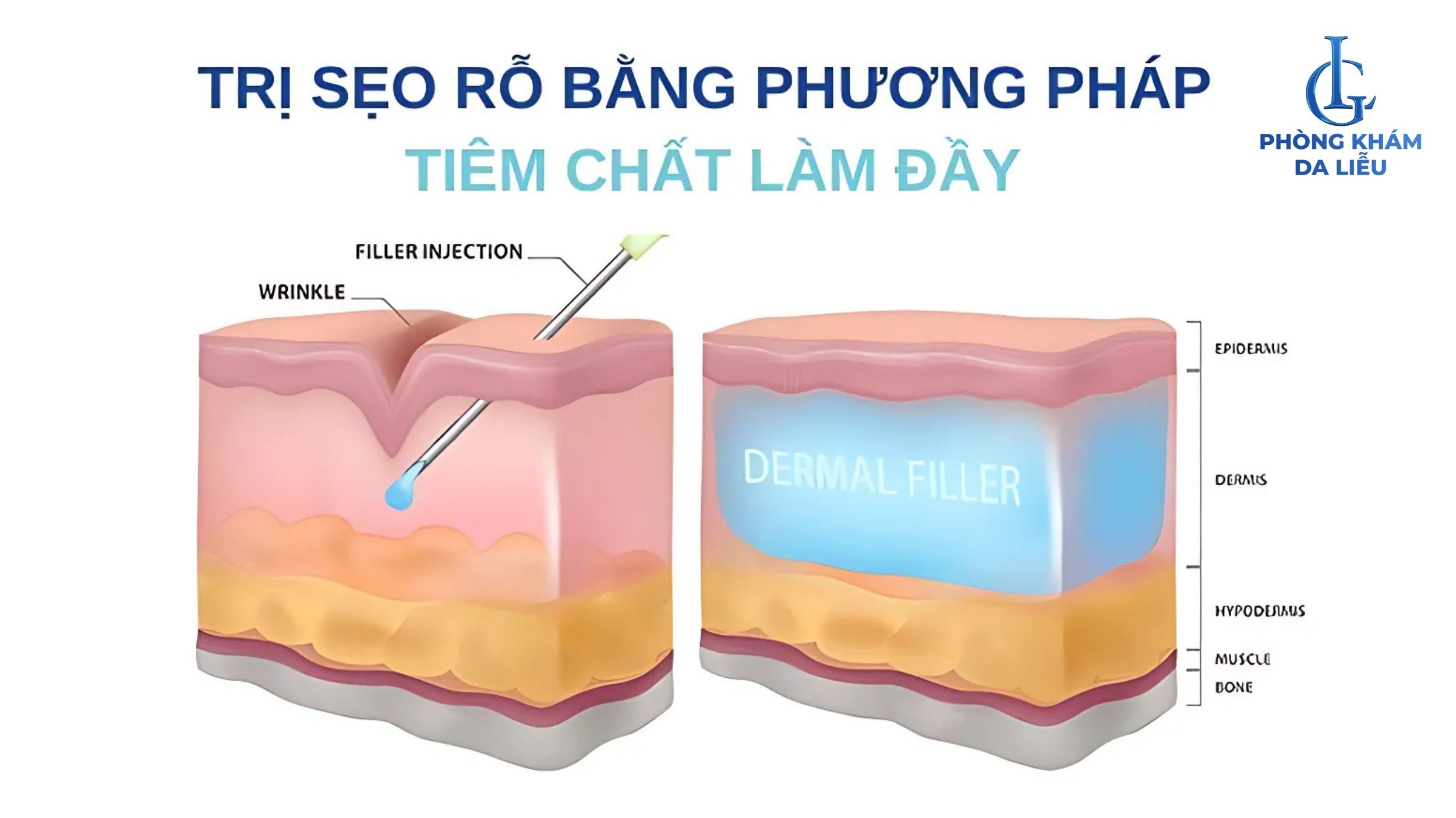 Tiêm chất làm đầy