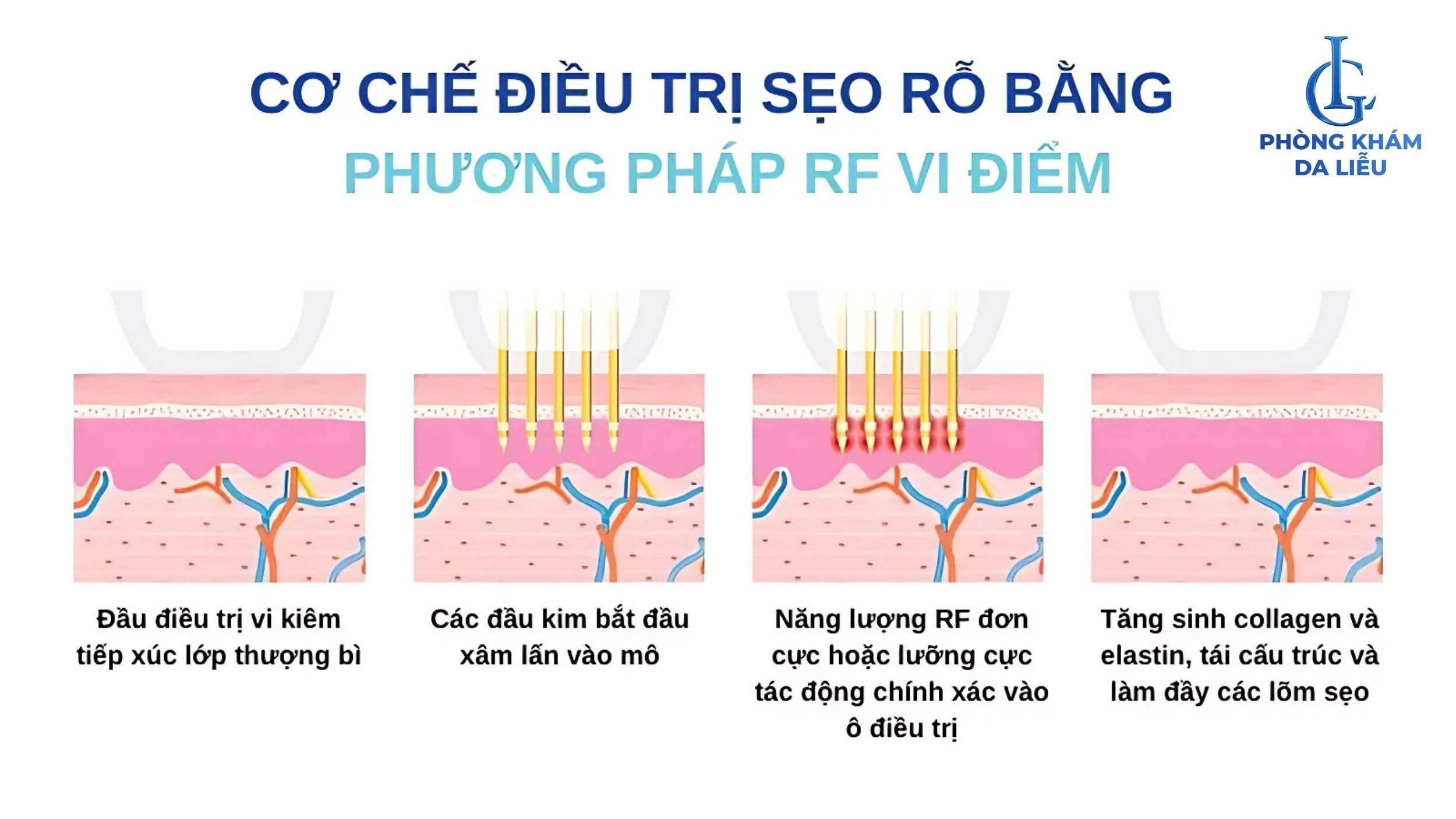 RF vi điểm trị sẹo rỗ