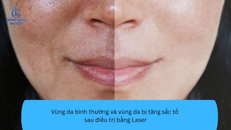 ai không nên điều trị sẹo bằng Laser