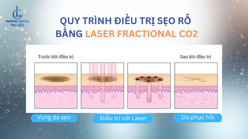 trị sẹo rỗ bằng laser co2 có hết không