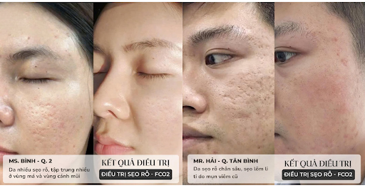 kết quả điều trị sẹo rỗ