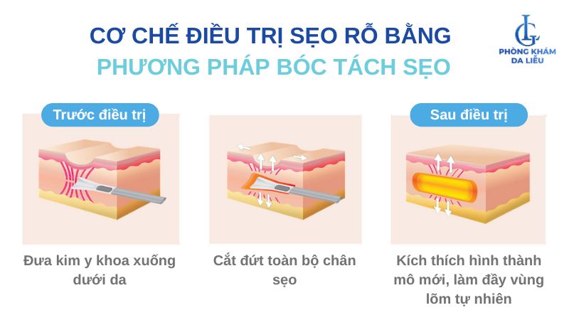điều trị sẹo rỗ bằng bóc tách đáy sẹo