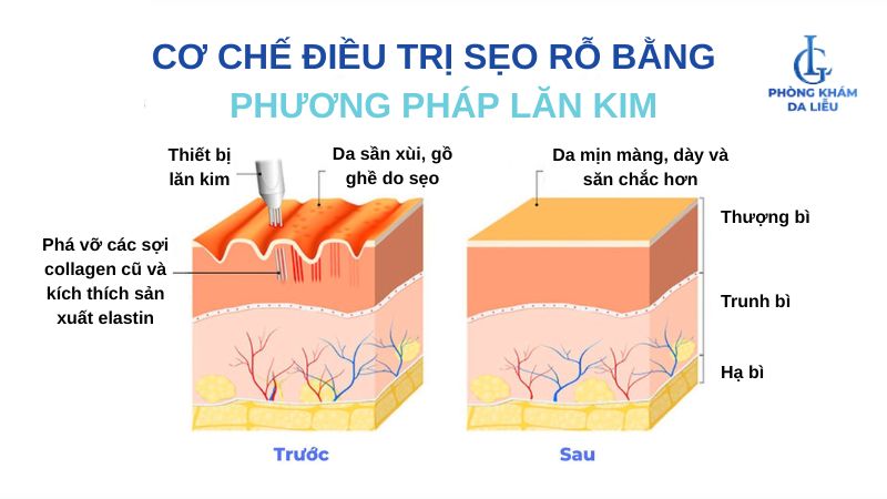 điều trị sẹo rỗ bằng lăn kim