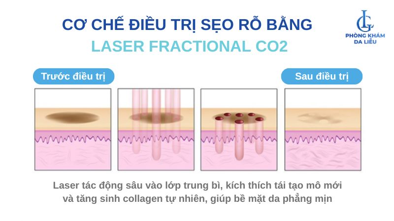 điều trị sẹo rỗ bằng laser co2
