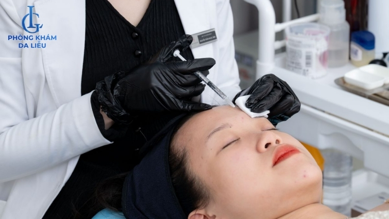 điều trị sẹo rỗ bằng mesotheraphy