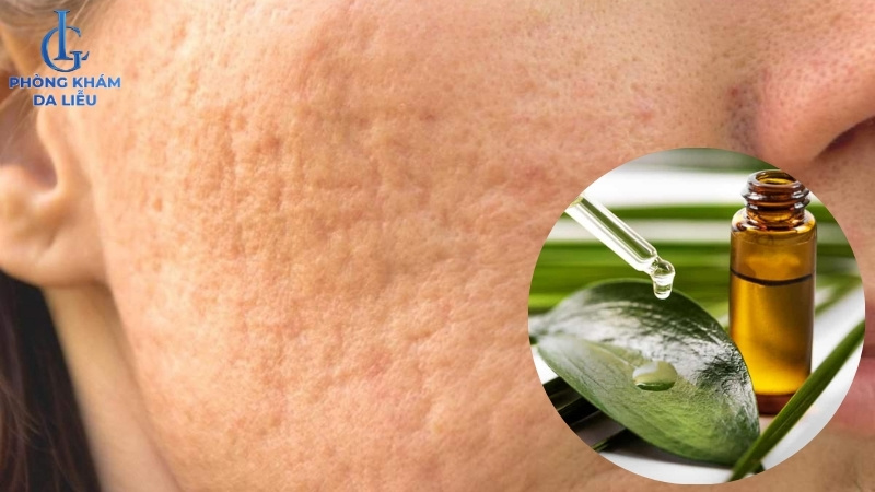 điều trị sẹo rỗ bằng nguyên liệu tự nhiên
