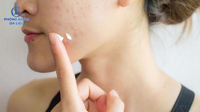 điều trị sẹo rỗ bằng thuốc bôi