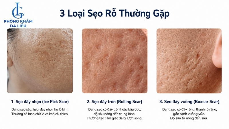 điều trị sẹo rỗ đau hay không tùy thuộc vào loại sẹo