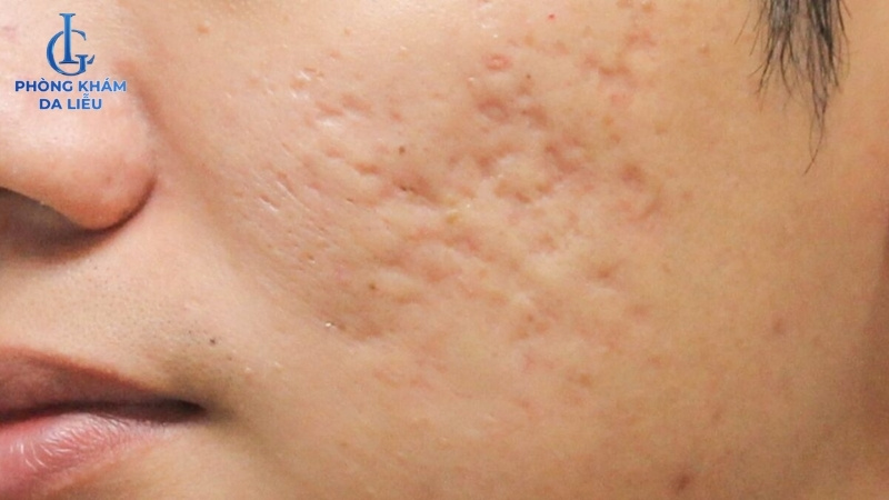 điều trị sẹo rỗ ở đâu uy tín