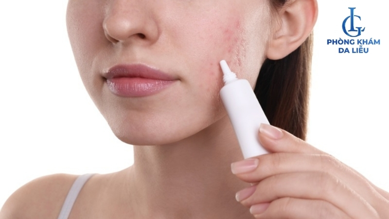 dùng tretinol trị sẹo rỗ