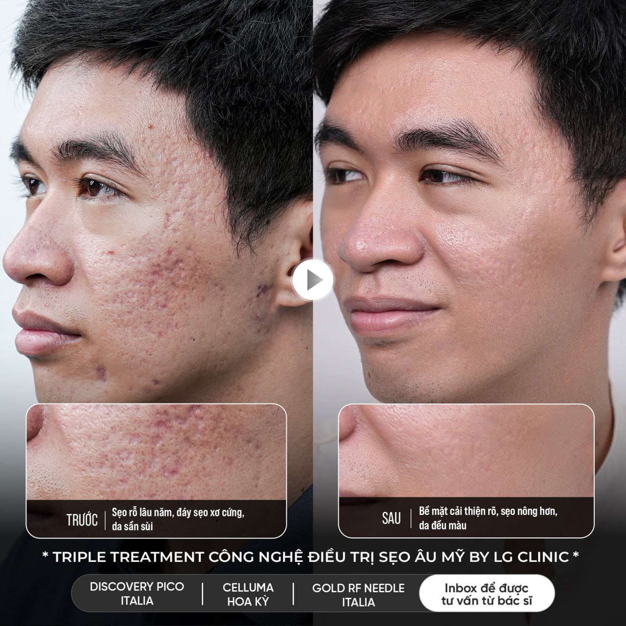 hiệu quả trị sẹo rỗ