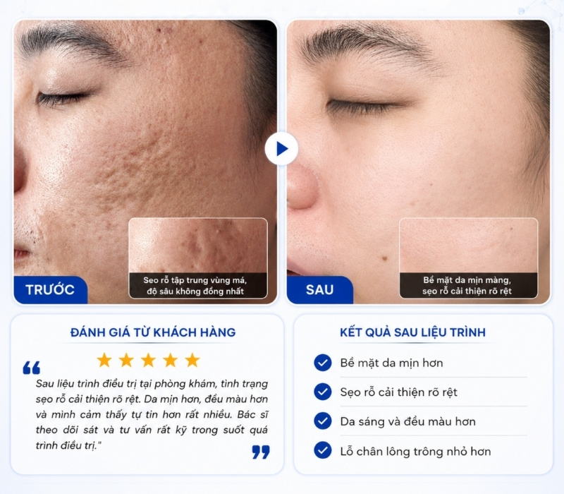 hình ảnh trước và sau khi điều trị sẹo lõm