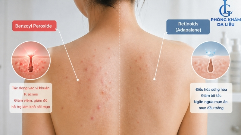 hoạt chất điều trị mụn lưng ở nữ