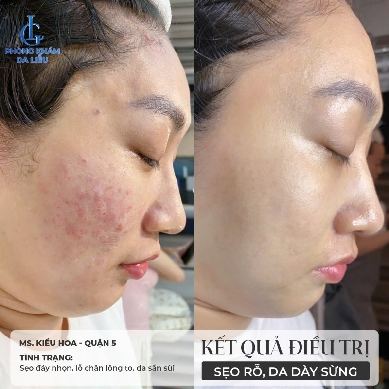 kết quả điều trị sẹo rỗ