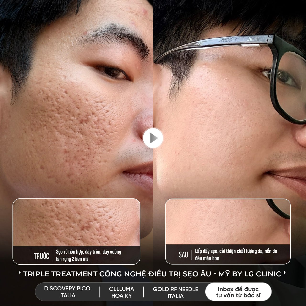 kết quả điều trị sẹo rỗ