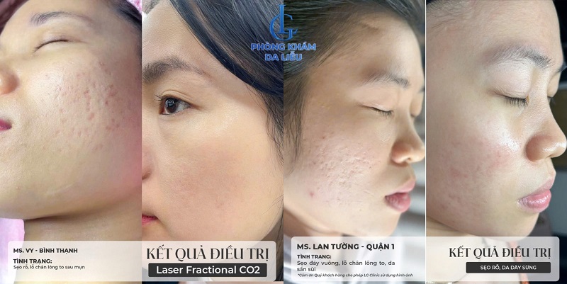 Hình ảnh minh họa kết quả điều trị sẹo rỗ