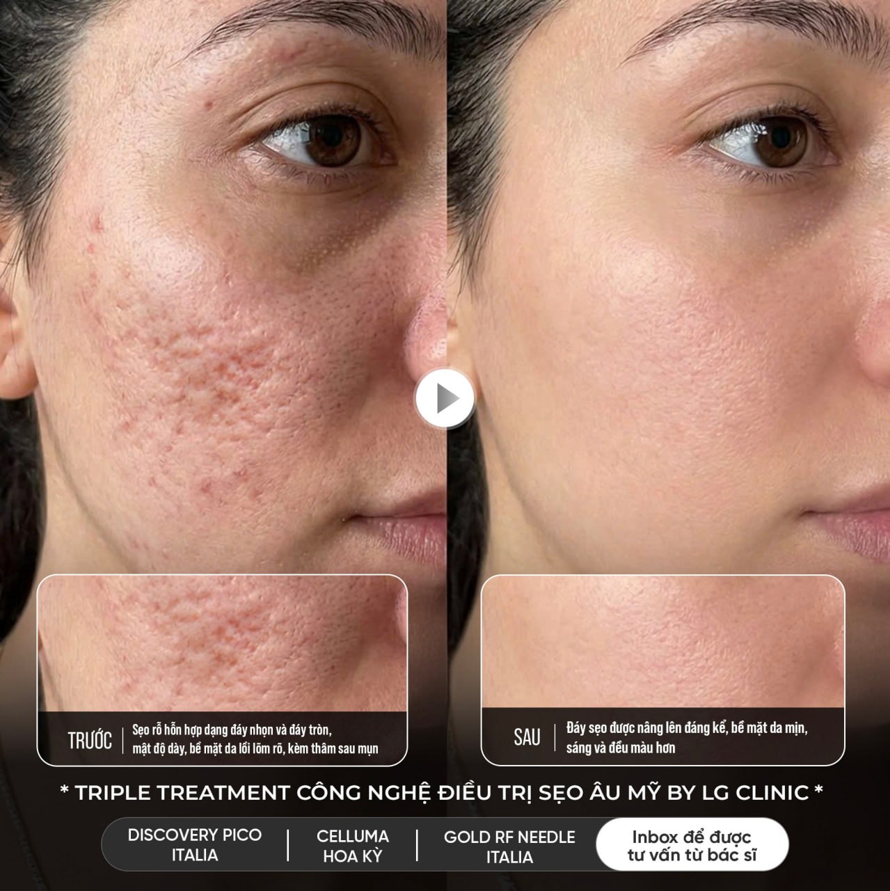 kết quả trị sẹo rỗ