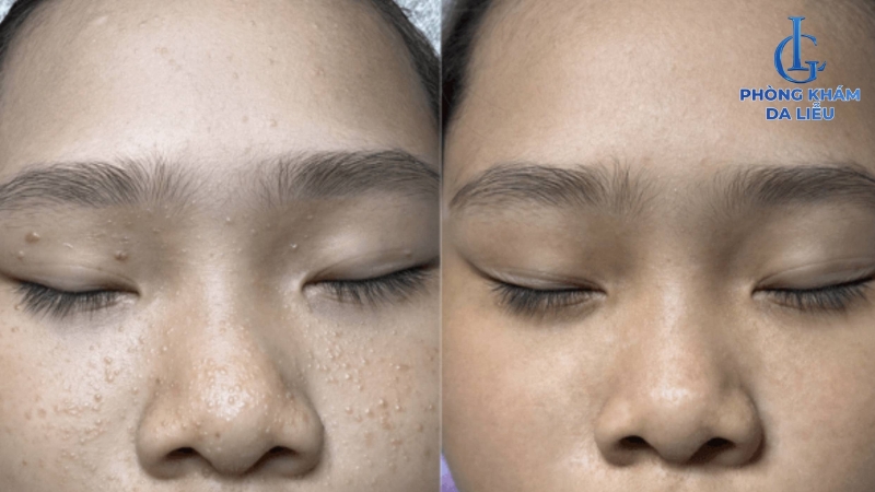 Hiệu quả trị mụn cơm
