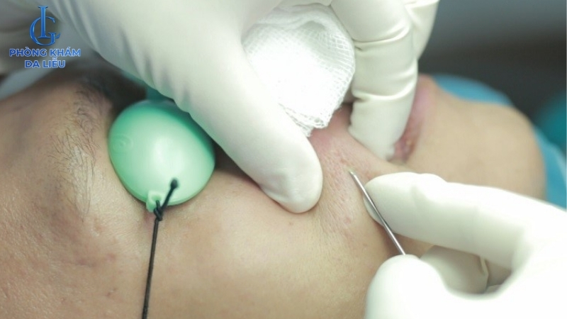 ngưỡng đau của mọi người khác nhau khi trị sẹo rỗ