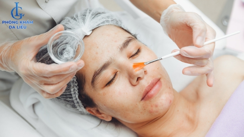 peel da trị sẹo lõm tại nhà