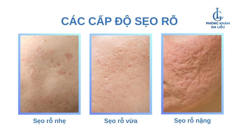 phân loại sẹo rỗ