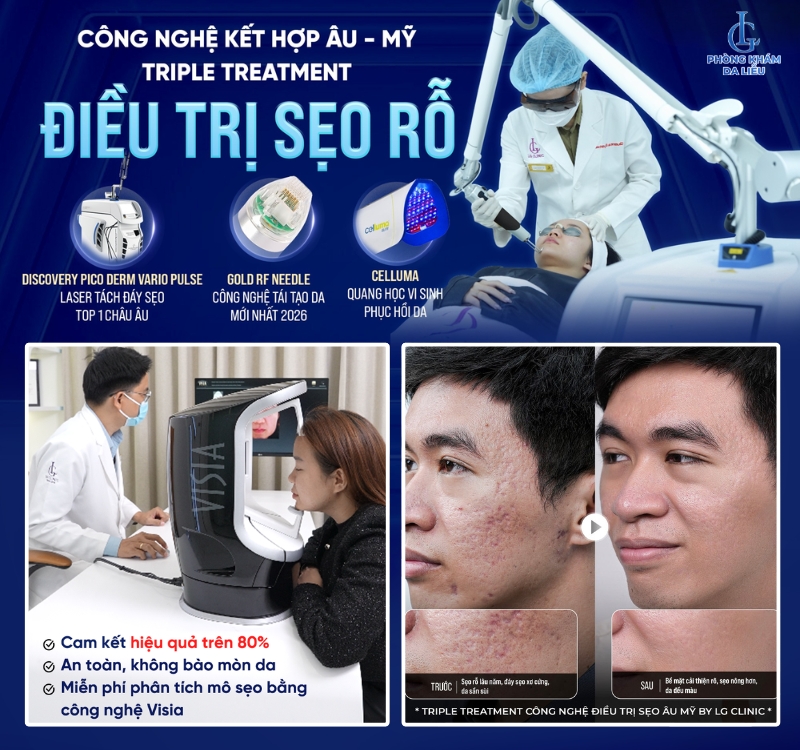 phương pháp điều trị sẹo rỗ