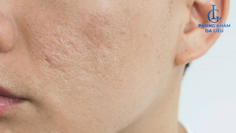 retinol điều trị sẹo rỗ