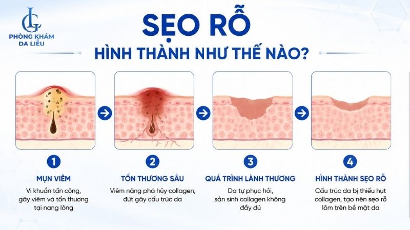 Sẹo rỗ hình thành như thế nào