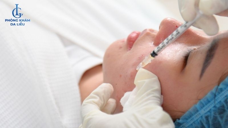 tiêm filler đầy sẹo rỗ