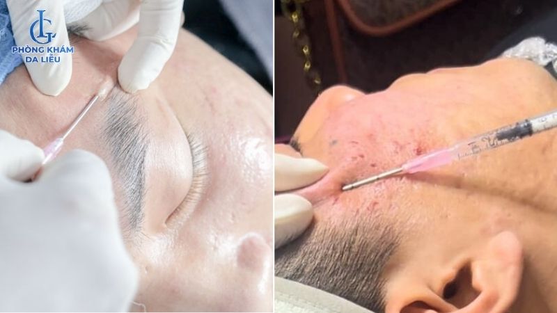 bóc tách đáy sẹo rỗ