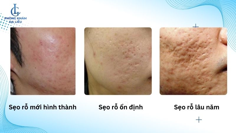 sẹo rỗ có tự hết không