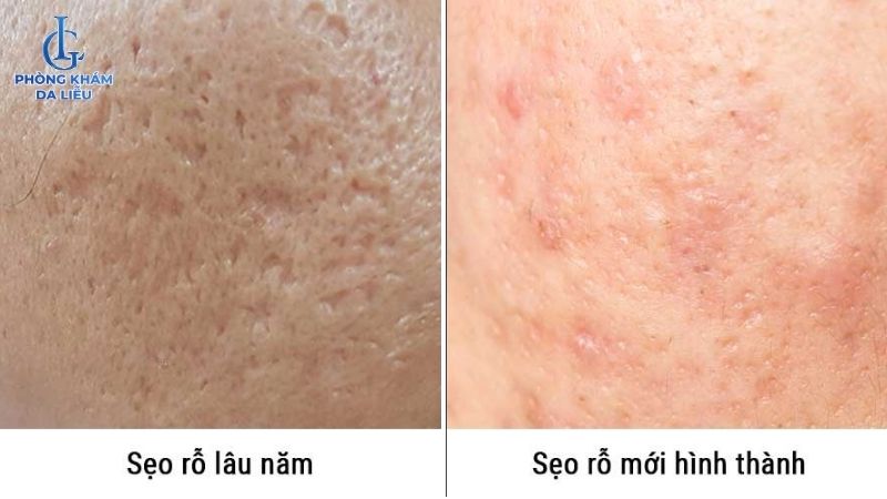 Sẹo rỗ mới và sẹo rỗ lâu năm