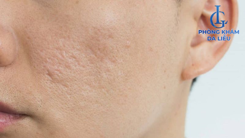 Sẹo rỗ nhẹ có tự hết không