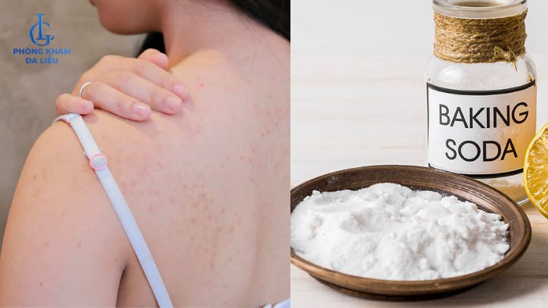 Cách trị mụn lưng với Baking soda