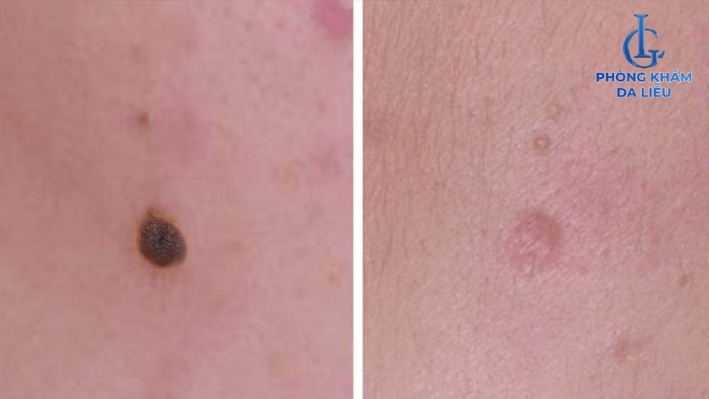 tẩy nốt ruồi có bị sẹo lõm