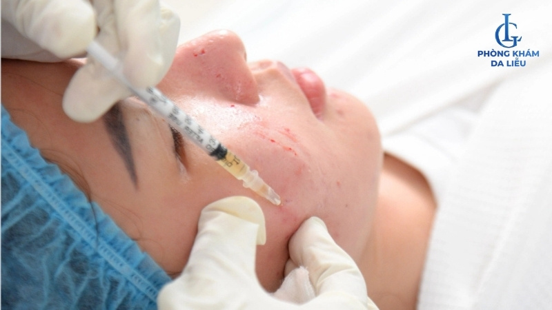 tế bào gốc điều trị sẹo rỗ