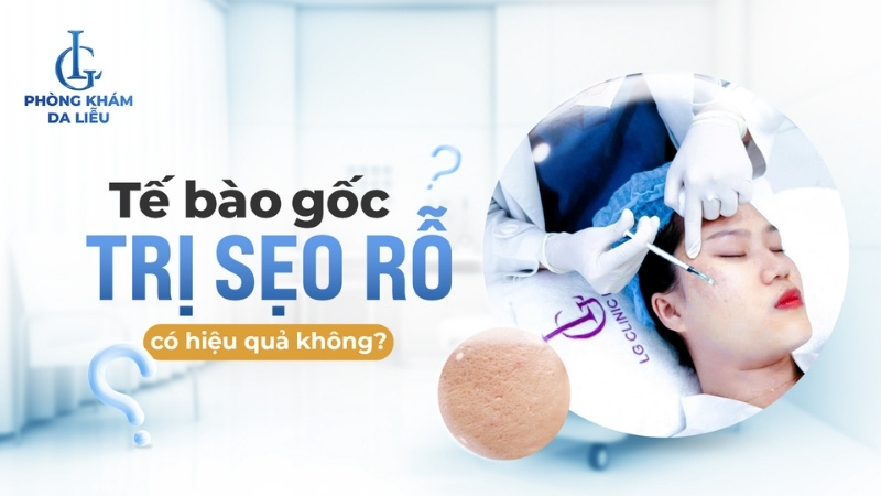 tế bào gốc trị sẹo rỗ tốt