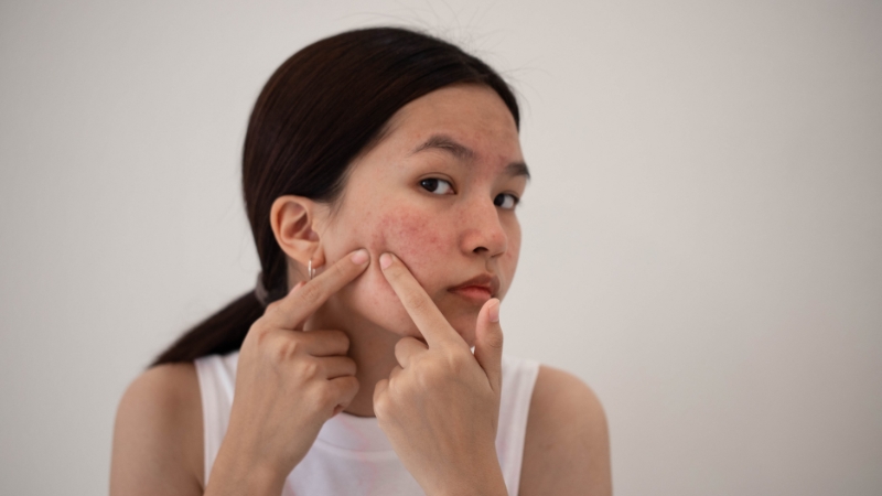 Nặn mụn