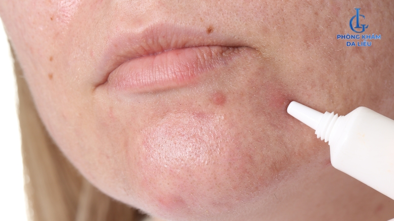 Bôi tretinoin