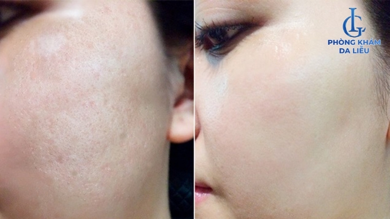 tretinoin trị sẹo rỗ hiệu quả